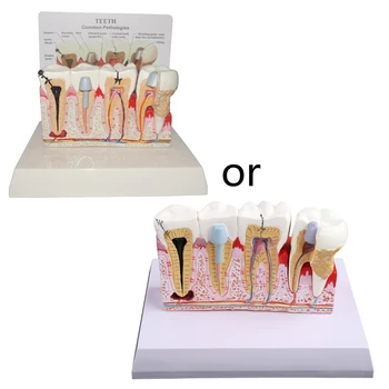 7x5.9x5.1in Модел на преподаване и обяснение на пациентите за изследване на зъбния кариес, модел показва патология на зъбите